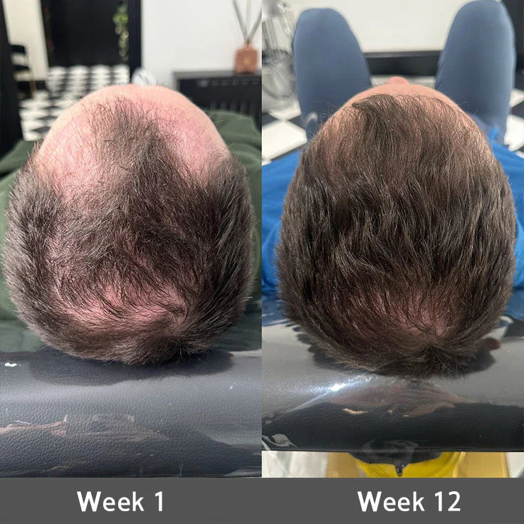 Highly Effective Biotin & Rosemary Hair Growth Serum - Advanced Scalp Treatment for Thinning Hair