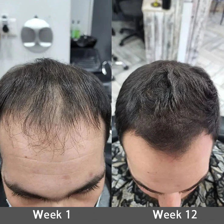 Highly Effective Biotin & Rosemary Hair Growth Serum - Advanced Scalp Treatment for Thinning Hair