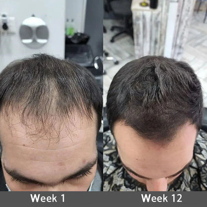 Highly Effective Biotin & Rosemary Hair Growth Serum - Advanced Scalp Treatment for Thinning Hair