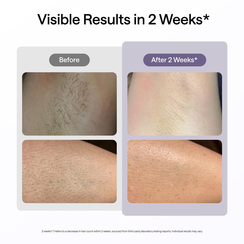 Advanced IPL Laser Hair Removal Device with Ice-Cooling Technology and Dual Lights