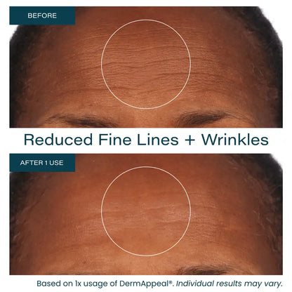 Microdermabrasion Facial Exfoliate Treatment - Powerful Resurfacing for All Skin Types
