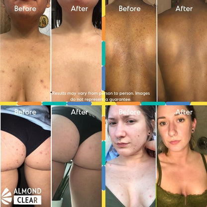 Level 2 Mandelic Acid Serum - Body Acne, Folliculitis and Hyperpigmentation Treatment