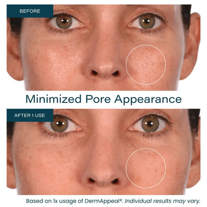 Microdermabrasion Facial Exfoliate Treatment - Powerful Resurfacing for All Skin Types