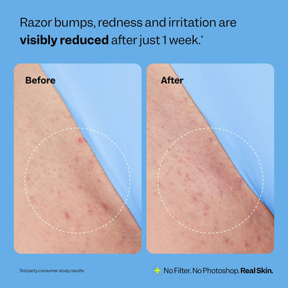 Smoothing Solution Ingrown Hair Treatment (1.69 oz) - BHA, AHA, PHA, Niacinamide, Licorice